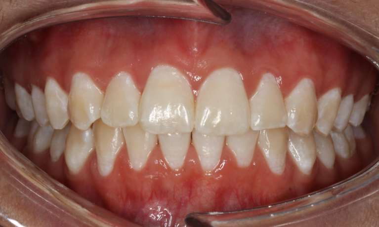 Correcting-Over-jet-with-deep-bite-After-Image