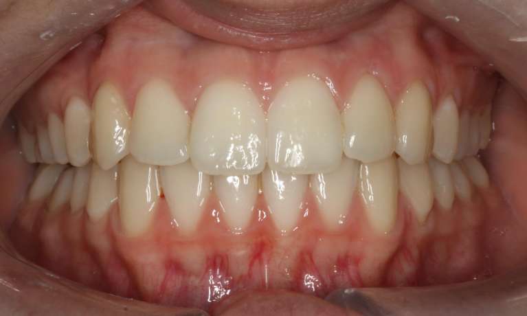 Correcting-Open-Bite-After-Image