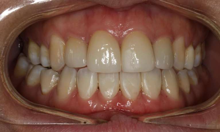 Ceramic-Veneers-After-Image
