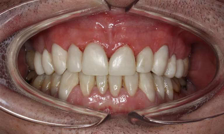 Full-Mouth-Reconstruction-After-Image