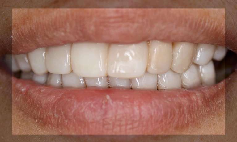 Gum-Reconstruction-with-Gum-Disease-After-Image