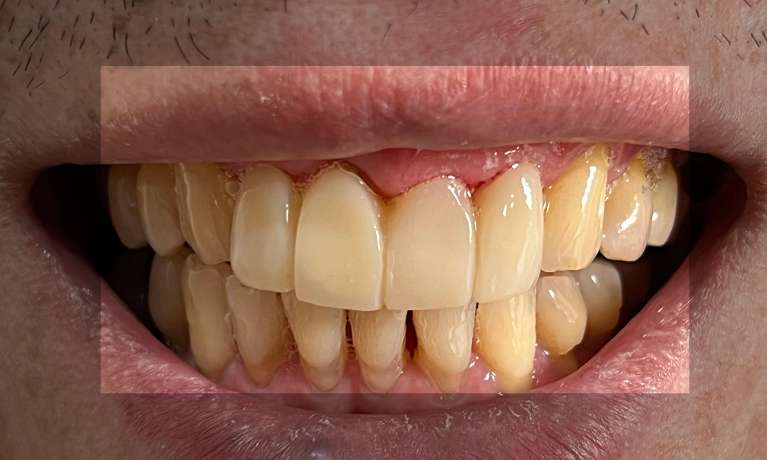 Composite veneers