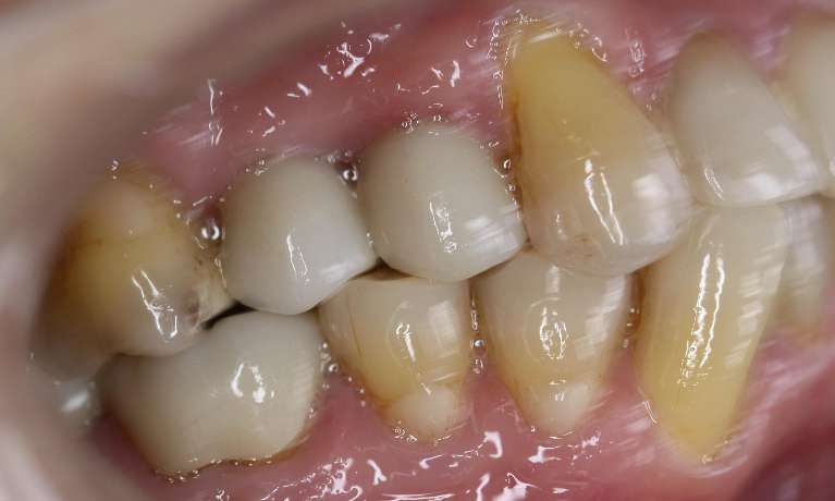 Single-tooth-implants-After-Image