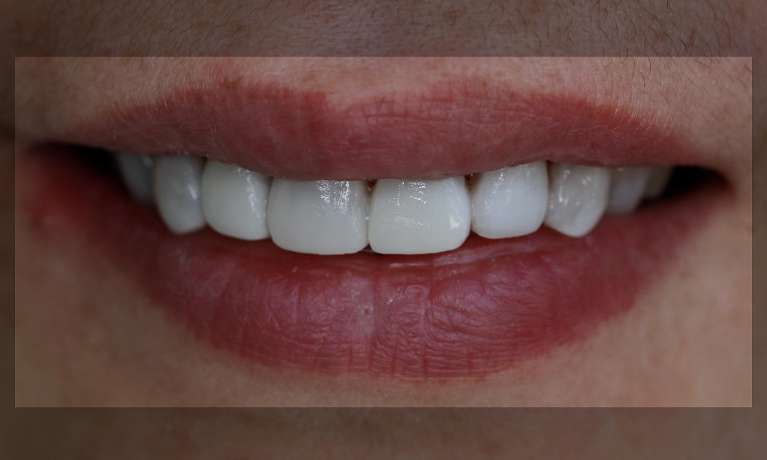 Smile-design-masking-tetracycline-stained-teeth-After-Image