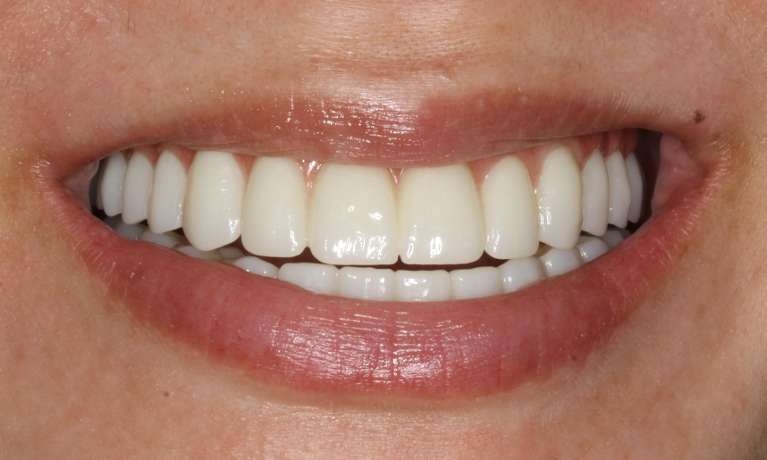 Upper-and-Lower-jaws-All-on-X-After-Image