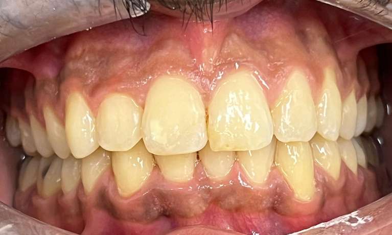 Correcting-Deep-Bite-After-Image