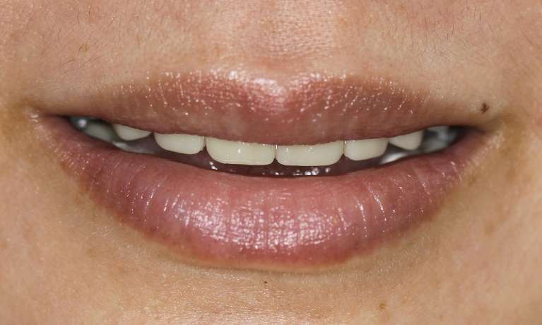 Restored youthful smile