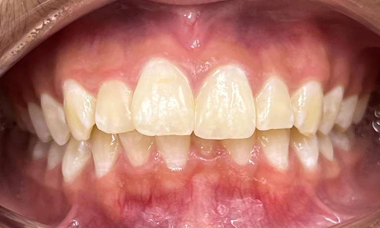 Correcting-Over-jet-with-deep-bite-Before-Image