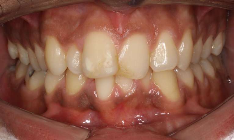 Correcting-Deep-Bite-Before-Image