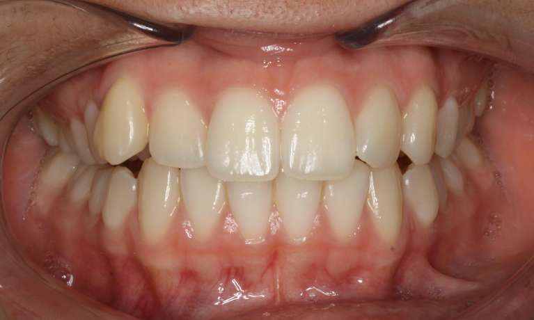 Correcting-Open-Bite-Before-Image