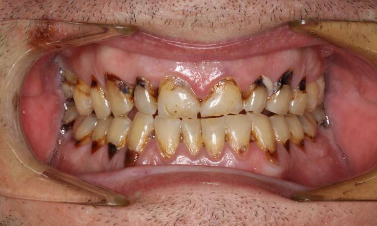 Full-Mouth-Reconstruction-Before-Image