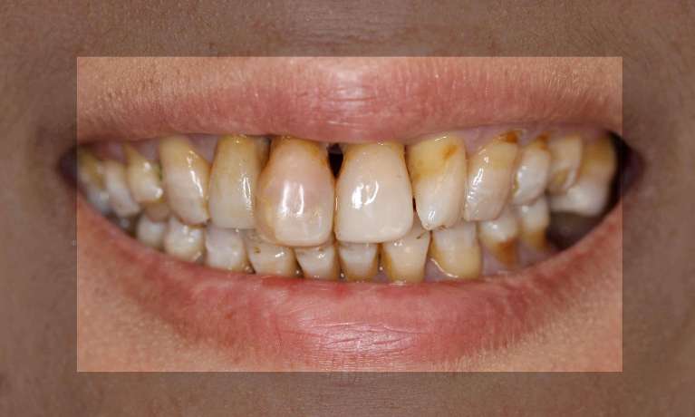 Gum-Reconstruction-with-Gum-Disease-Before-Image