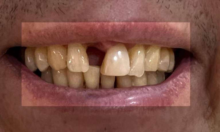 not enough space for implant tooth