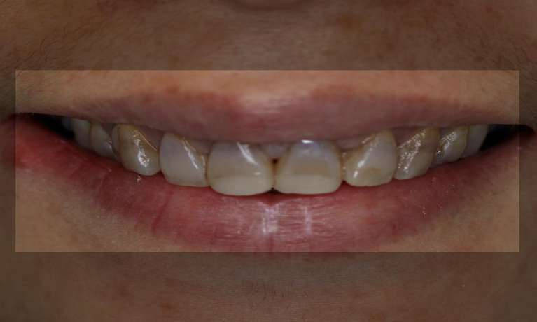 Smile-design-masking-tetracycline-stained-teeth-Before-Image