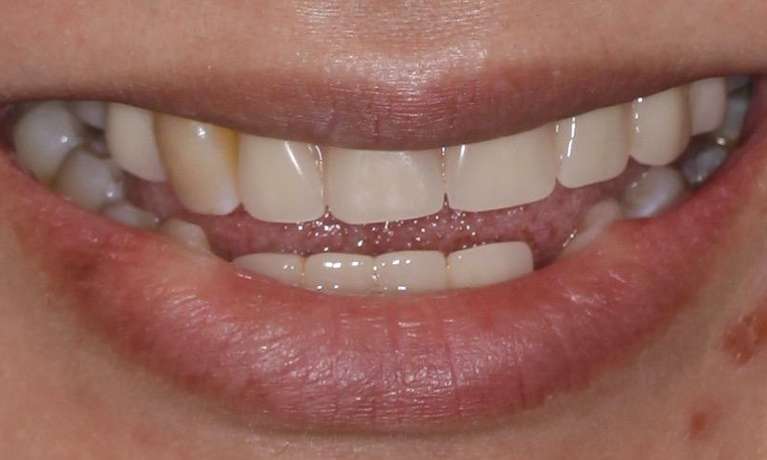 Denture teeth